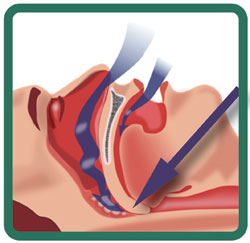 The obstructive sleep apnea
